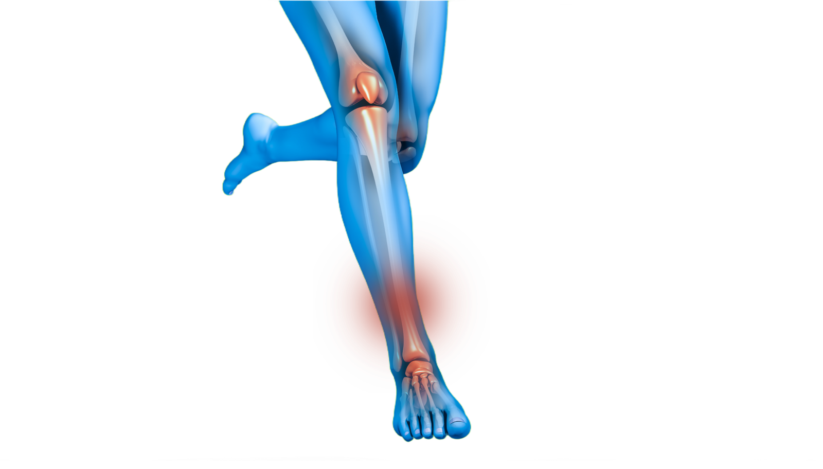 Shin Splints